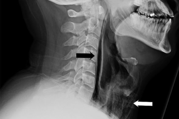 A radiograph of a person's neck, showing an air pocket in the throat area.