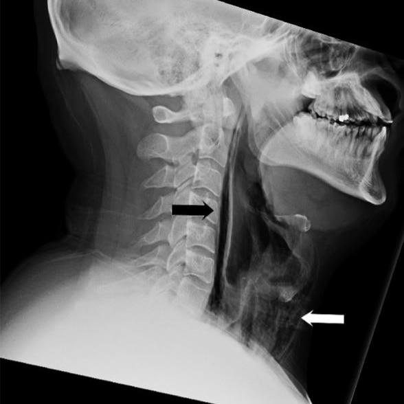 A radiograph of a person's neck, showing an air pocket in the throat area.