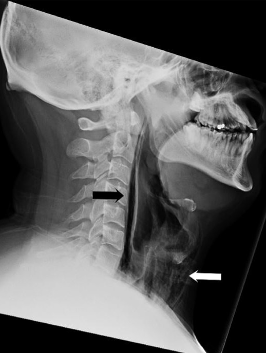 An x-ray of a person's neck, showing an air pocket in the throat area.