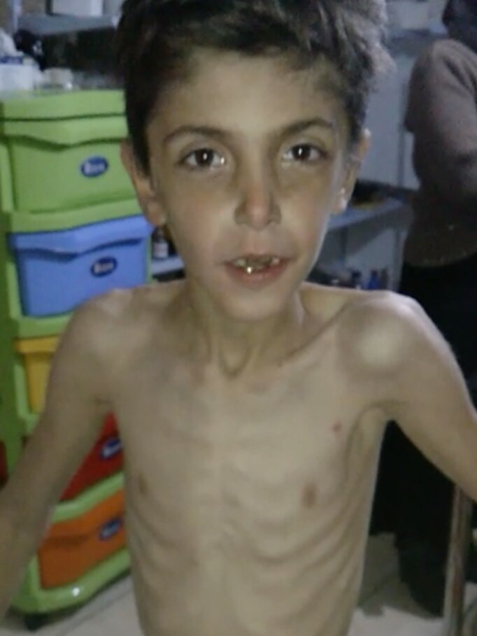 An emaciated children in the beseiged town of Madaya
