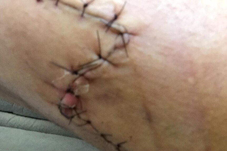 Calvin Treacy leg wound