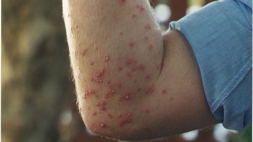 A man's arm with many blisters on it from fire ant bites