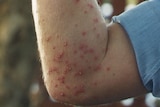 A man's arm with many blisters on it from fire ant bites