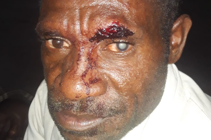 A West Papuan man with a face injury.