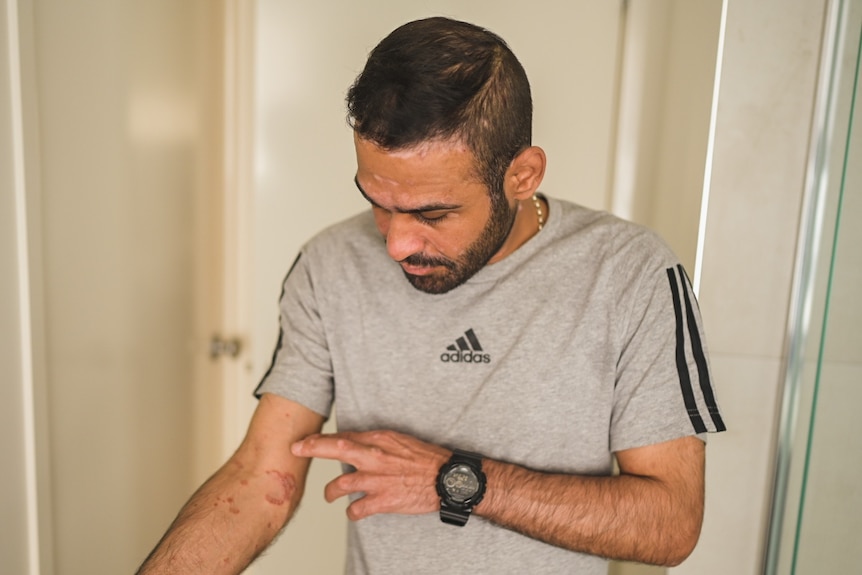 Amin Afravi shows a bad rash on his arm