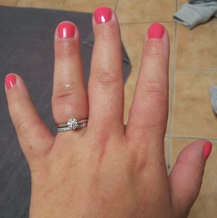 A close up of a woman's swollen hand.