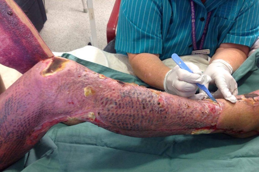 A red leg covered in skin graphs with sores and a nurse's hands in white gloves holding a scalpel.