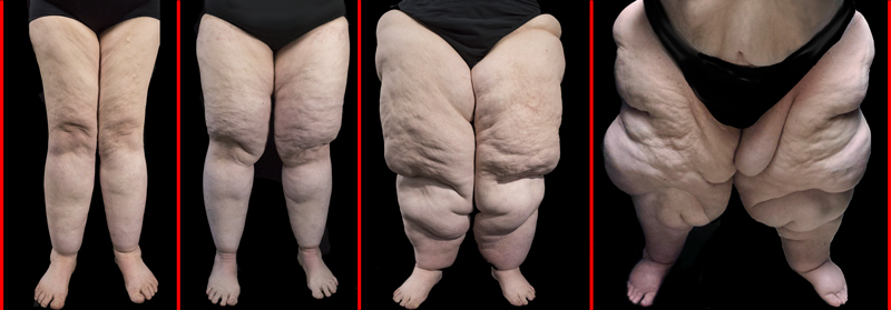 four different-size sets of legs affected by lipoedema, each gradually having a higher percentage of fat
