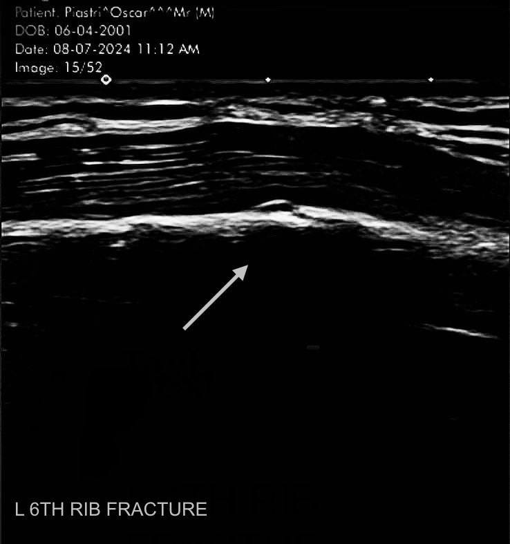 An X-ray of Oscar Piastri showing a fractured sixth left rib, dated July 8, 2024.