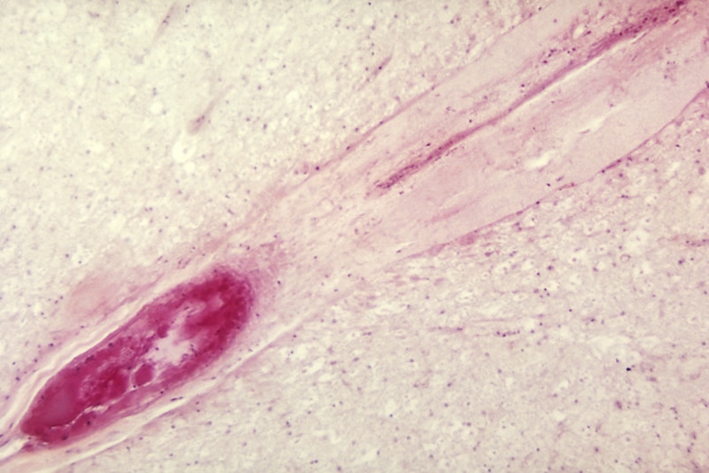 A photomicrograph of the lumbar spinal cord depicting an infarct due to Polio Type III surrounding the anterior spinal artery.