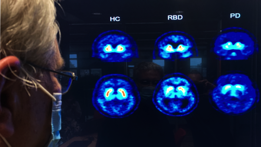 A doctor looks at six bright blue brain scans.
