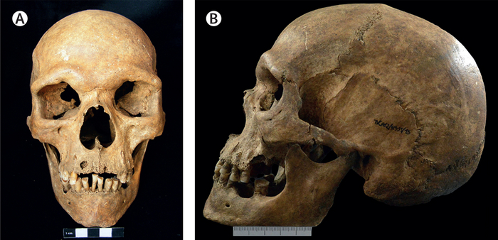  A front and side view of a human skull. It is missing front teeth and has an underbite