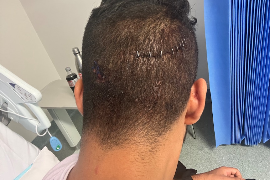 The back of a man's head shows a gash has been stapled