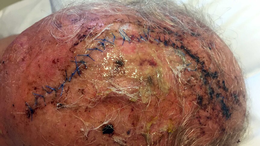 A close up of a head wound with stitches.