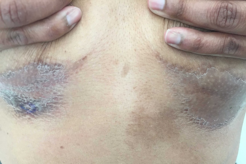 close-up of large scabs under breasts of woman