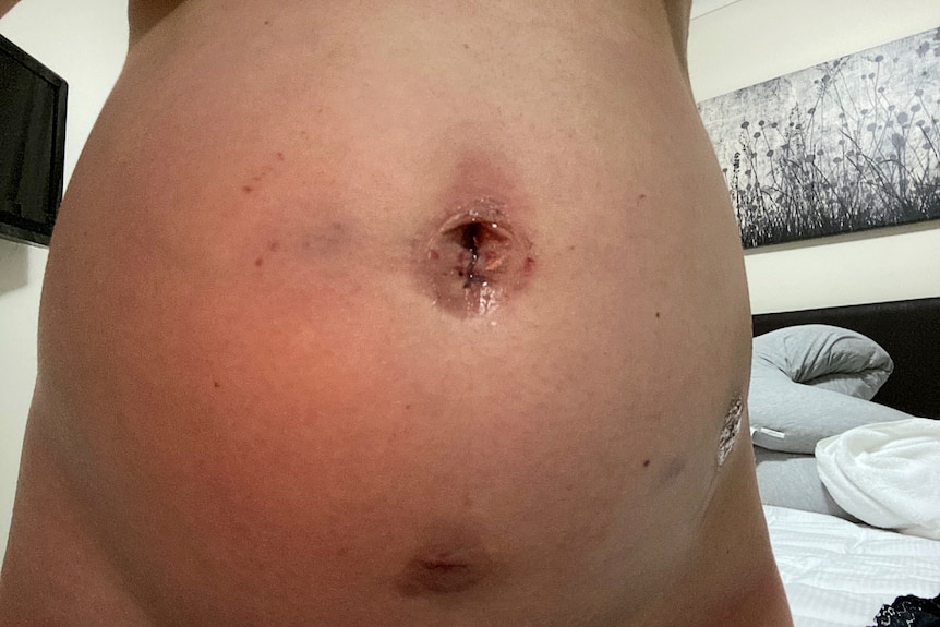 A swollen-looking abdomen and red belly button after laparoscopic surgery.