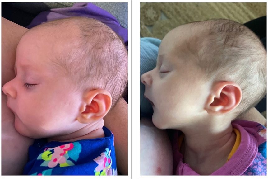 Side profile of a baby in two comparison shots, one looking very skinny and one looking chubbier.