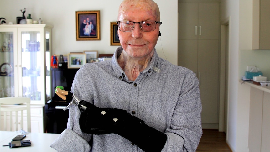 Terry Lee suffered burns to 75 per cent of his body, losing both of his hands and an eye, as a result of the Pinery bushfire.