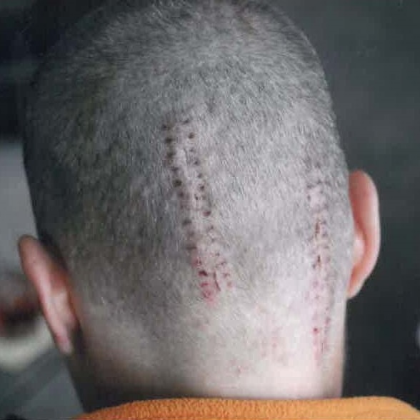 Scars on the back of Tasmanian Labor Senator Catryna Bilyk who had two tumours removed in March 2008.