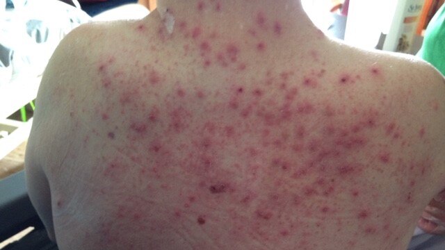 Spots and scabs on a man's back.