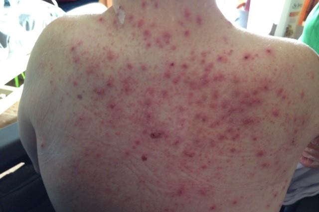 Spots and scabs on a man's back.