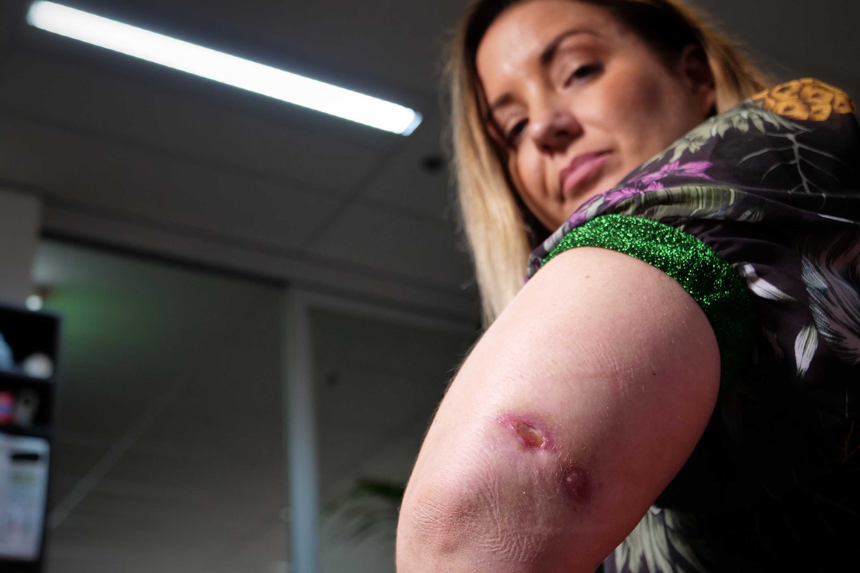 A woman with a wound on her elbow.