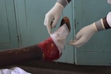 Kenyan doctor practices maggot debridement therapy