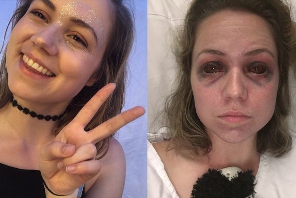 A before and after image of Falls Festival crush victim Maddy, showing her with two black eyes after the incident.