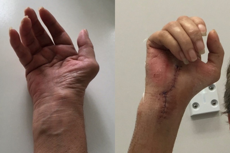 a composite of a wrist before and after surgery