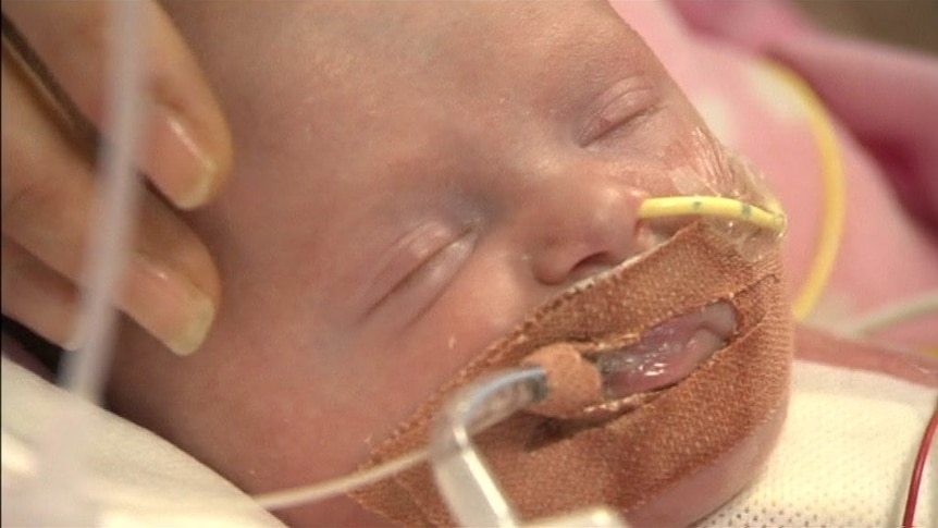 Baby born with heart outside her body survives surgery