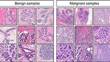 Benign and malignant breast cancer slides at different magnifications