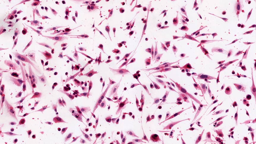 Glioma (brain cancer) cells