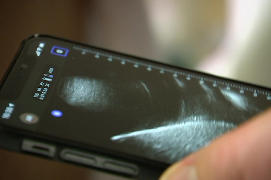 A close-up of a phone screen showing an ultrasound.