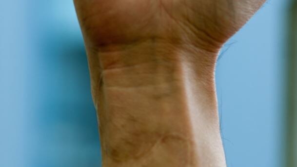A close up shot of a curved scar on a wrist