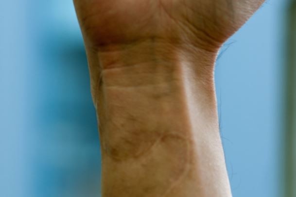 A close up shot of a curved scar on a wrist