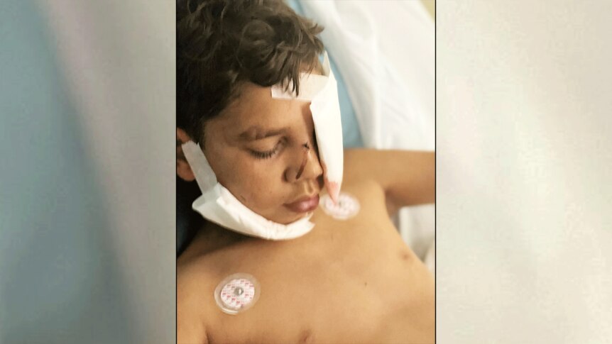 A boy with bandages to his face in a hospital bed