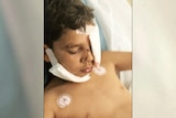 A boy with bandages to his face in a hospital bed