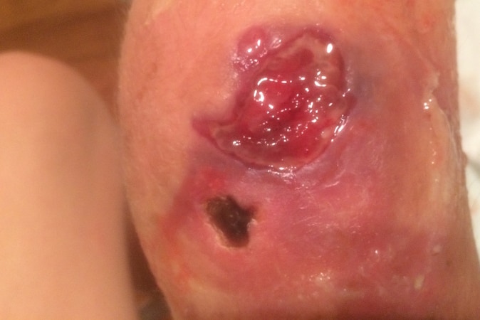 Mornington Peninsula teen Ella Crofts contracted a flesh eating bacteria that attacked her leg.