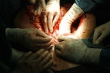 Doctors' hands extract organs from a patient's stomach