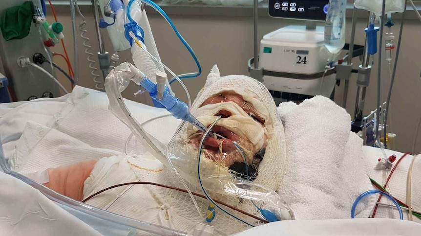 A person lying on a hospital bed badly burnt and intubated.