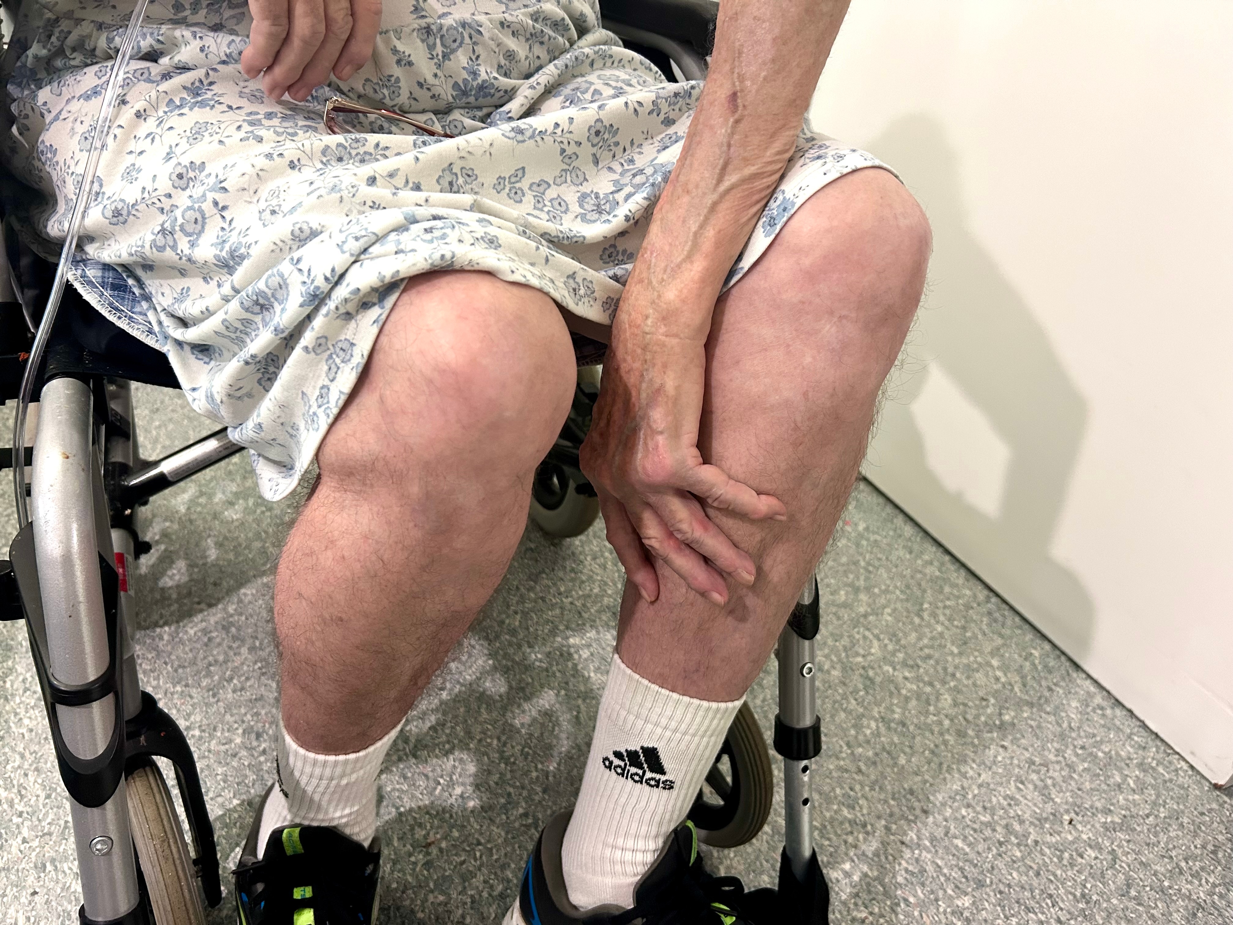 Las piernas de una persona mayor en silla de ruedas son muy delgadas