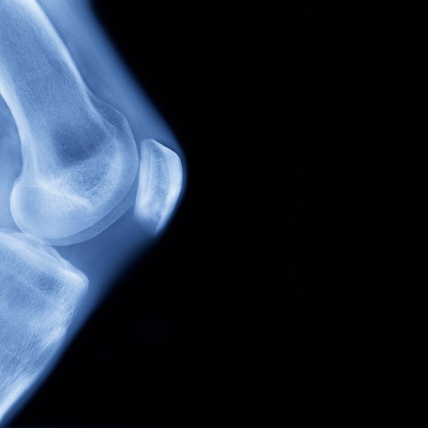 x-ray of knee joint against black background