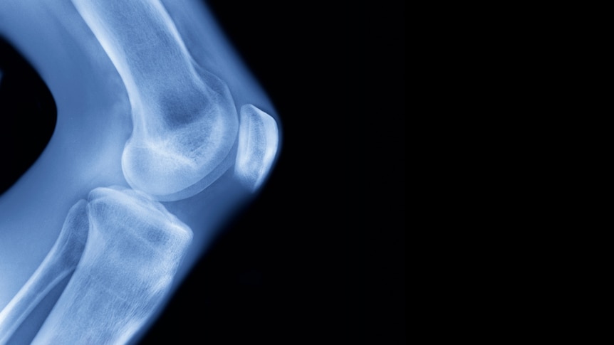 x-ray of knee joint against black background