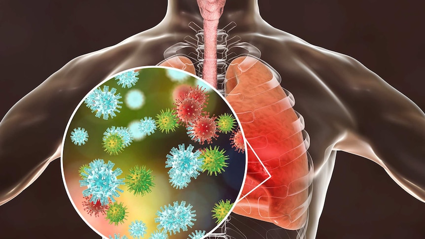 Viral pneumonia graphic