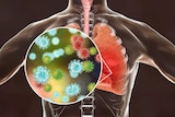 Viral pneumonia graphic