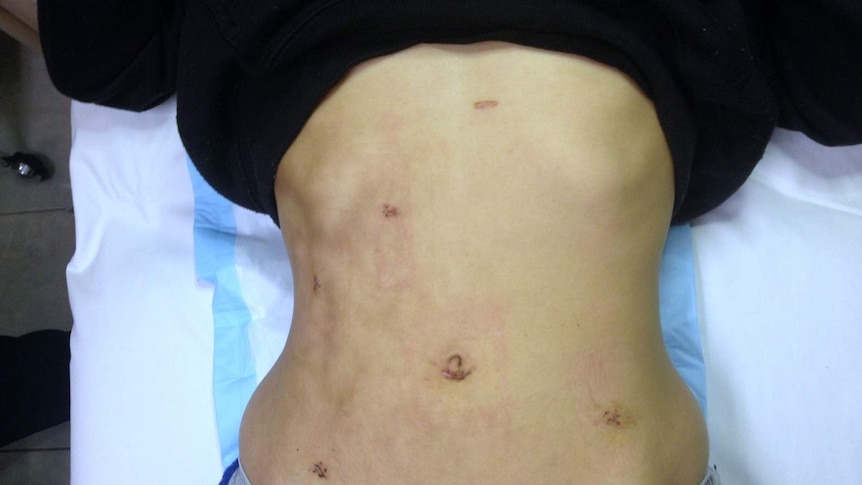 Surgery scars on Jessica Panetta.
