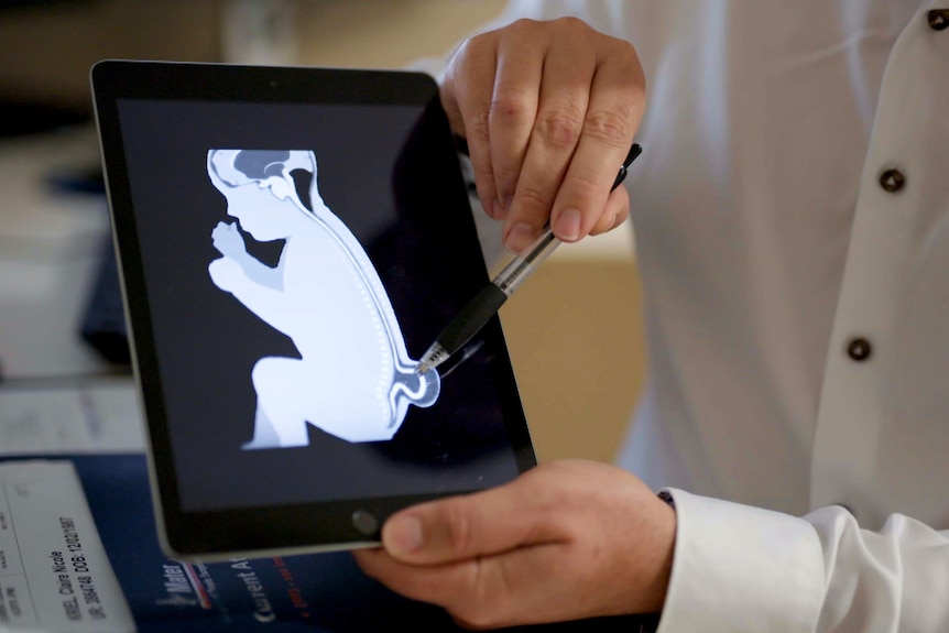 A doctor's hands holding up a tablet, showing what a spina bifida lesion looks like.