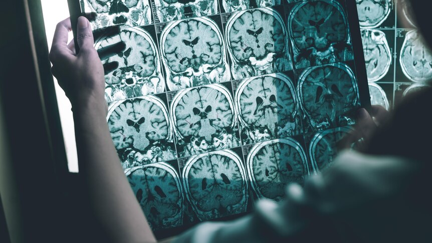 Alzheimer’s disease captured on an MRI