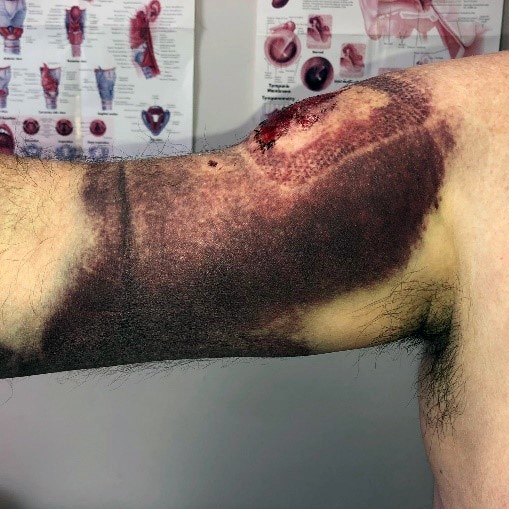 A man's deeply bruised arm with a large bump and cut.
