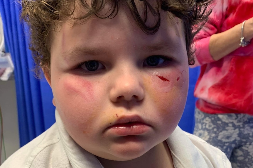 Boy with cuts on his face and bruising on his eyes